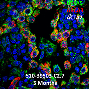 Human Lung Confocal Imaging S10-39503 ABCA3 homozygous mutation showing expressions of HSPA5, ABCA3, and ACTA2