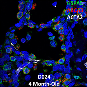Human Lung Confocal Imaging Donor D024 ABCA3 homozygous mutation showing expressions of HSPA5, ABCA3, and ACTA2