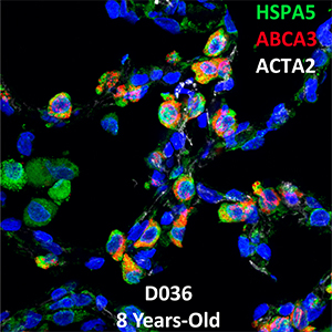 Human Lung Confocal Imaging Donor D036 ABCA3 homozygous mutation showing expressions of HSPA5, ABCA3, and ACTA2
