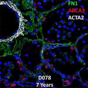 7 Year-Old Human Lung with Asthma Immunofluorescence and Confocal Imaging Donor D078 Showing Expression of FN1, ABCA3, and ACTA2