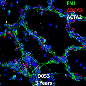 3 Year-Old Human Lung Immunofluorescence and Confocal Imaging Donor D053 Showing Expressions of FN1, ABCA3, and ACTA2