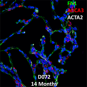 14 Month-Old Human Lung Immunofluorescence and Confocal Imaging Donor D072 Showing Expression of FN1, ABCA3, and ACTA2