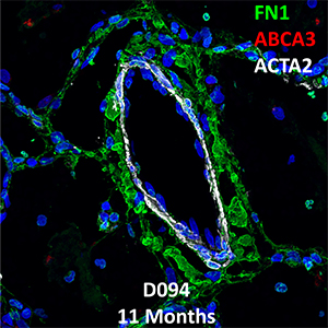 11 Month-Old Human Lung Immunofluorescence and Confocal Imaging Donor D094 Showing Expression of FN1, ABCA3, and ACTA2