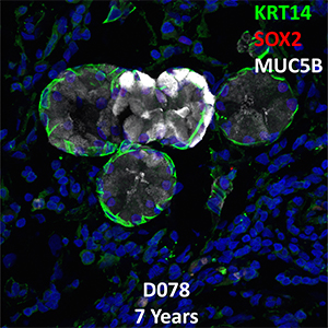 7 Year-Old Human Lung Donor with Asthma KRT14, SOX2, and MUC5B Confocal Imaging