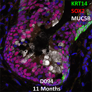 11 Month-Old Human Lung KRT14, SOX2, and MUC5B Confocal Imaging
