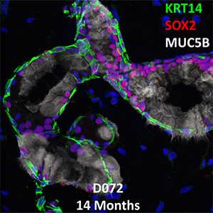 14 Month-Old Human Lung KRT14, SOX2, and MUC5B Confocal Imaging