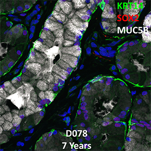 7 Year-Old Human Lung with Asthma Immunofluorescence and Confocal Imaging Donor D078 Showing Expression of KRT14, SOX2, and MUC5B 18B3