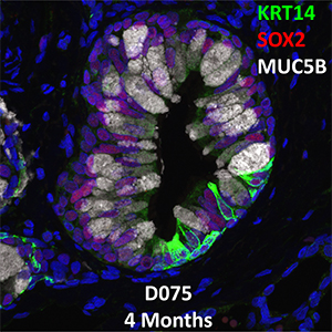 4 Month-Old Human Lung Immunofluorescence and Confocal Imaging Donor D075 Showing Expression of KRT14, SOX2, and MUC5B