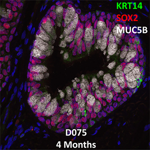 4 Month-Old Human Lung Immunofluorescence and Confocal Imaging Donor D075 Showing Expression of KRT14, SOX2, and MUC5B 11A2