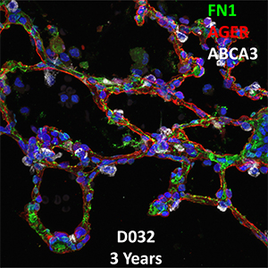 3 Year-Old Human Lung Immunofluorescence and Confocal Imaging Donor D032 Showing Expression of FN1, AGER, and ABCA3