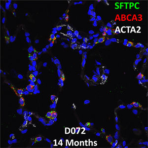 14 Month-Old Human Lung Immunofluorescence and Confocal Imaging Donor D072 Showing Expression of SFTPC, ABCA3, and ACTA2