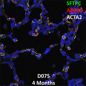 4 Month-Old Human Lung Immunofluorescence and Confocal Imaging Donor D075 Showing Expression of SFTPC, ABCA3, ACTA2