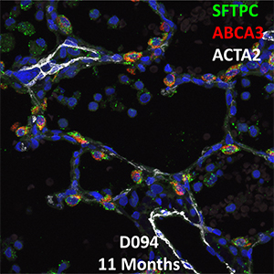11 Month-Old Human Lung Immunofluorescence and Confocal Imaging Donor D094 Showing Expression of SFTPC, ABCA3, and ACTA2