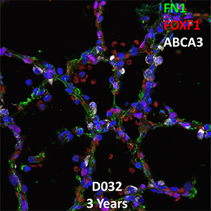3 Year-Old Human Lung Immunofluorescence and Confocal Imaging Donor D032 Showing Expression of FN1, FOXF1, and ABCA3
