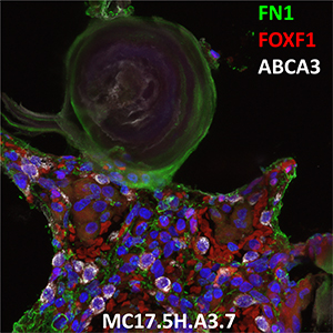 Human Lung Confocal Imaging MC17.5H.A3.7 showing expressions of FN1, FOXF1 and ABCA3