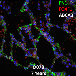 7 Year-Old Human Lung with Asthma Immunofluorescence and Confocal Imaging Donor D078 Showing Expression of FN1, FOXF1, and ABCA3