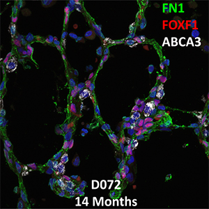 14 Month-Old Human Lung Immunofluorescence and Confocal Imaging Donor D072 Showing Expression of FN1, FOXF1, and ABCA3